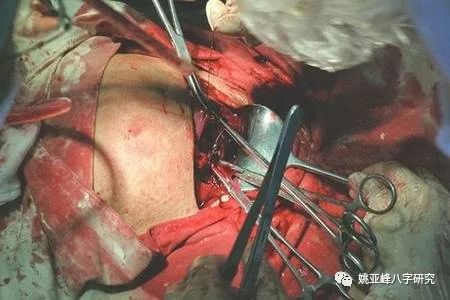 梦见二胎剖腹产生女孩_剖腹产生子择日_剖腹产生四胎的多吗